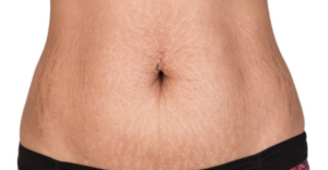 how to get rid of stretch marks